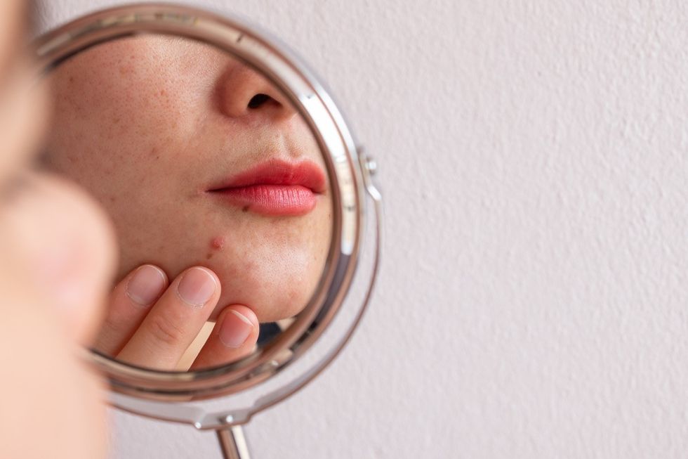 Mulher preocupada com acne olhando no espelho