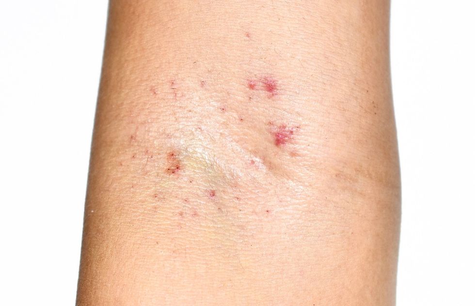 Grupos de manchas vermelhas ou petéquias na parte interna do cotovelo