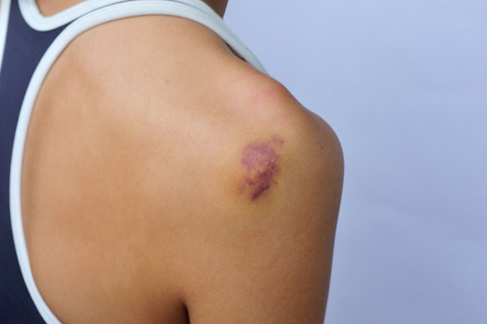 Um hematoma no ombro de uma mulher