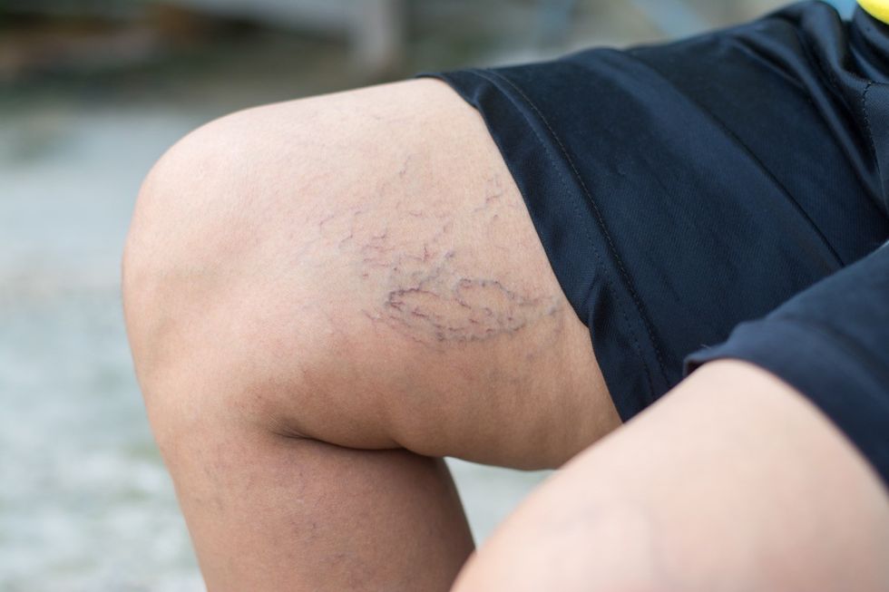 Mulher idosa com varizes nas pernas